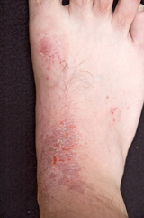 atopic-dermatitis-foot-160