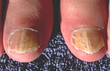 fungal_nail_infection_160