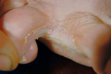 fungal_toe_infection_160